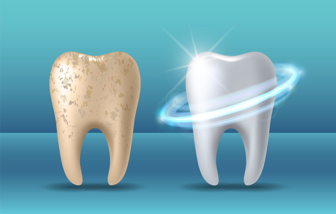 Whitening - Clínica Élite de Estética Dental