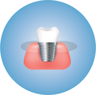 https://dentaltotalclinic.com/wp-content/uploads/2020/08/Implantes.png